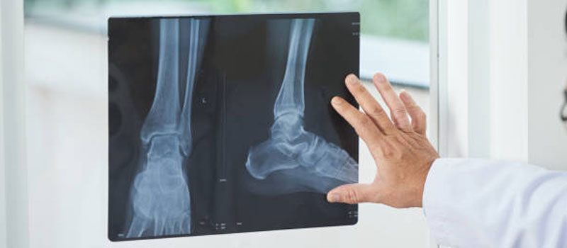 Fracture X-Ray at Home in Mumbai